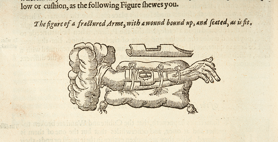 Illustration of a bone fracture